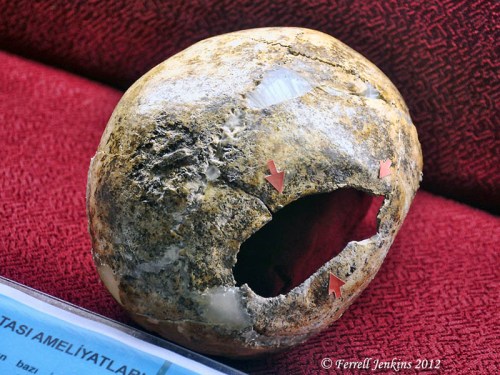 Example of Trepanation, Bronze Age III, Ikiztepe. Samsun Archaeological Museum. Photo by Ferrell Jenkins.